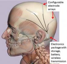 Implanted EEG system showing location of the SoC and electrodes.